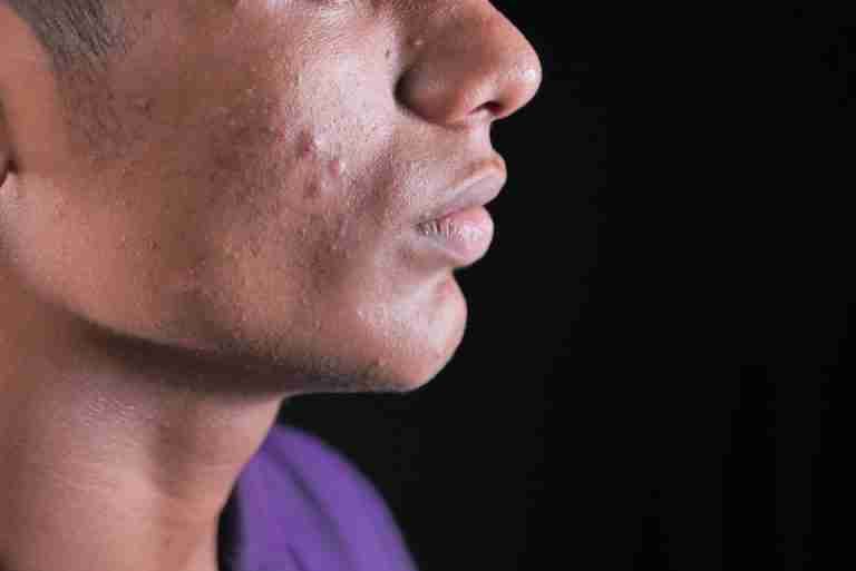 Side view close-up of a young man's face with visible acne on cheek and jawline.